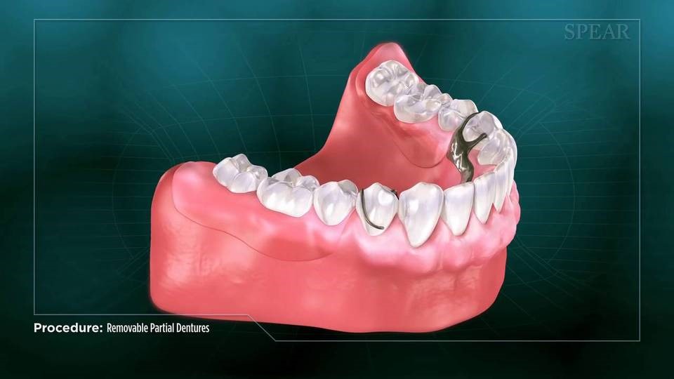 Upper Partial Dentures Baxter WV 26560